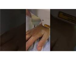 BBL Laser / Hand Rejuvenation / Spot Treatment