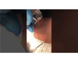 Mole Removal (Skin Tag) with CO2 Fractional Laser