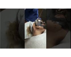 Carbon Peeling ( Dr Ebru Durmuş Kliniği)