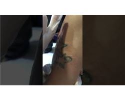 Tattoo Removal (Q-Switched + CO2 Fractional Laser)