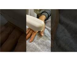 Hand Rejuvenation with Bblazer (Pigmentation/Spot Treatment)