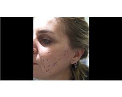 Face Lift with French Thread Lift