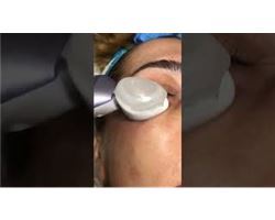 Frozen Eyes (Eye Area Wrinkles, Under-Eye Bags, Dark Circles)