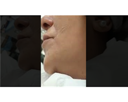 Frozen Face Treatment - Izmir