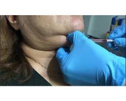 Double Chin Reduction (Silk Serum)