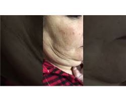 Double Chin Reduction / Fat Dissolving Lipolysis