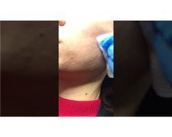 Collagen Injection