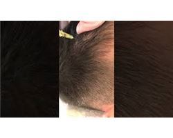Hair PRP Treatment (Revitalizing Hair Follicles, For Hair Loss)